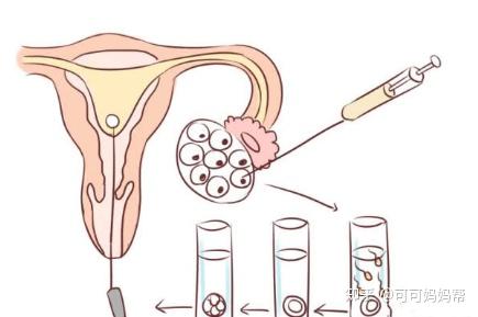 ICSI操作